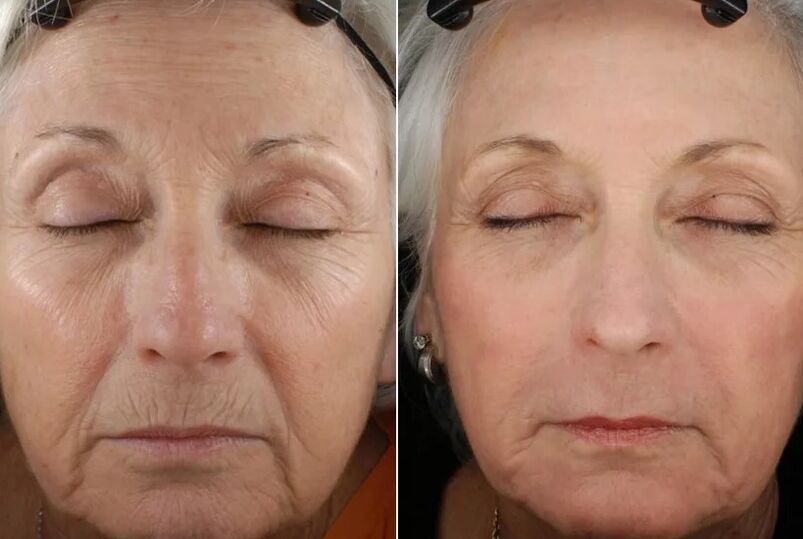 The results of fractional rejuvenation
