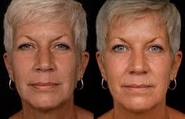 woman face before and after