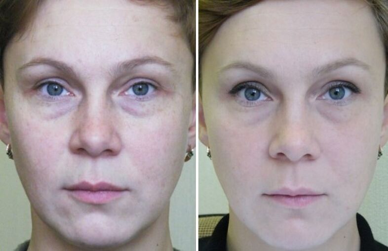 Photos before and after laser resurfacing.